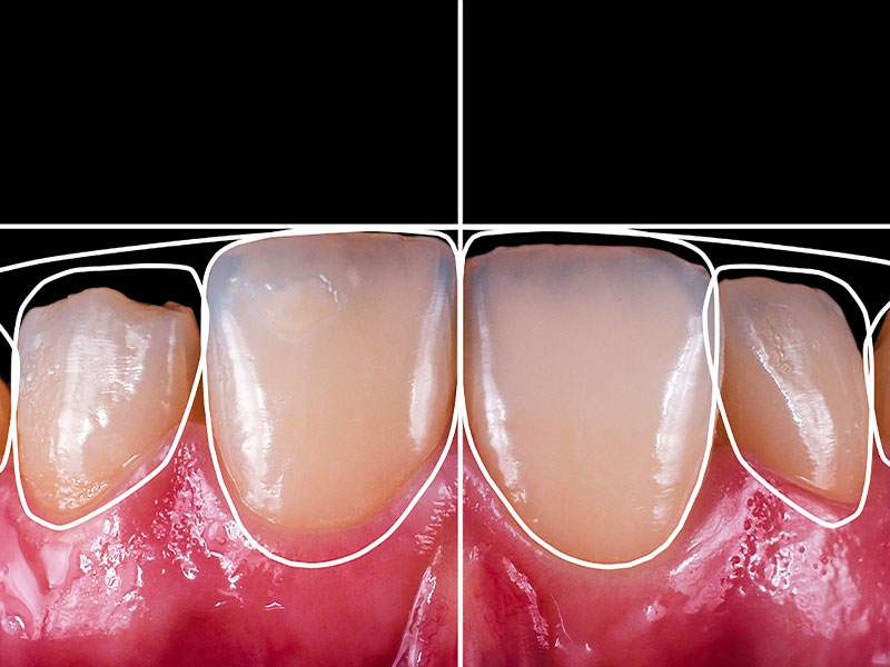 Digital smile design